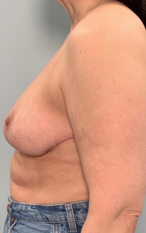 Breast Reduction Before & After Image