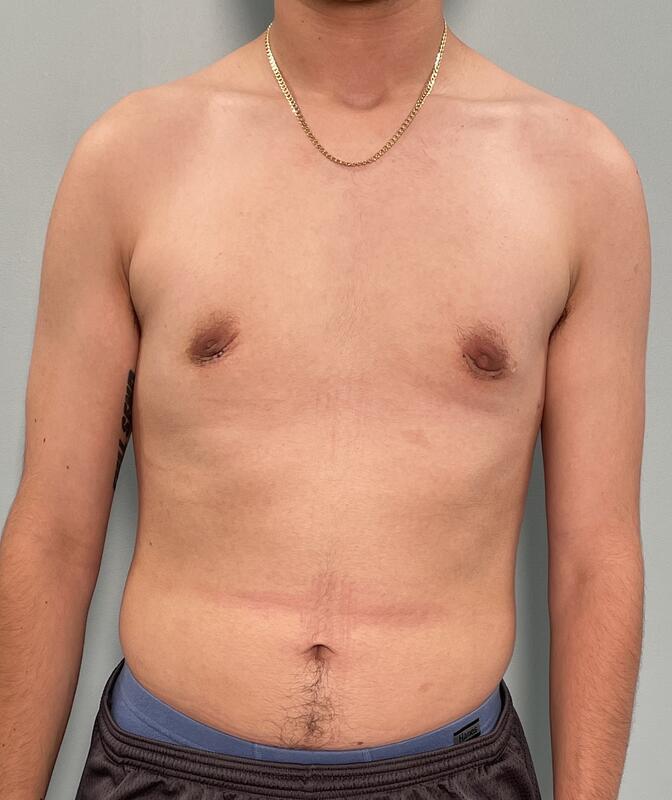 Gynecomastia Before & After Image