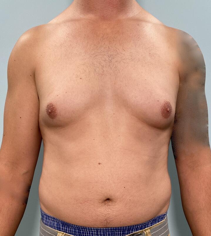Gynecomastia Before & After Image