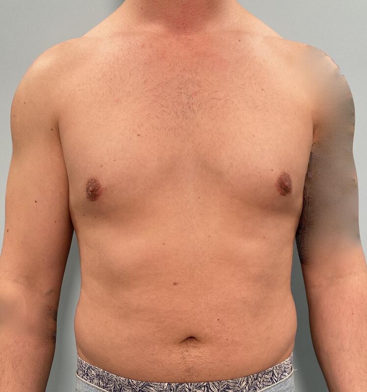 Gynecomastia Before & After Image