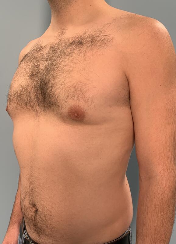 Gynecomastia Before & After Image