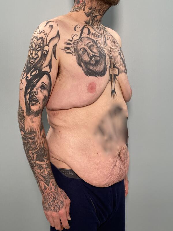 Gynecomastia Before & After Image