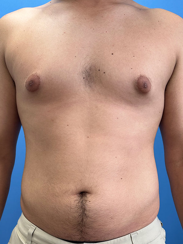 Gynecomastia Before & After Image