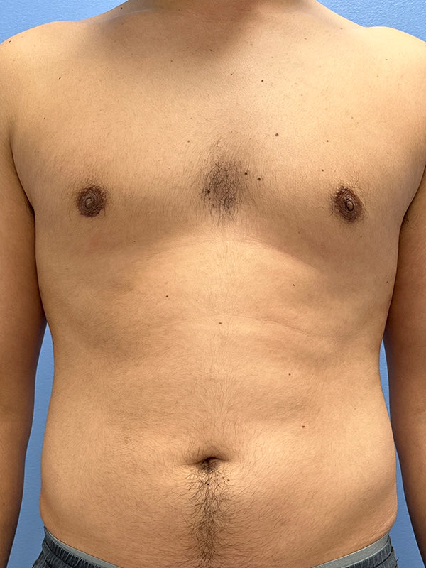 Gynecomastia Before & After Image