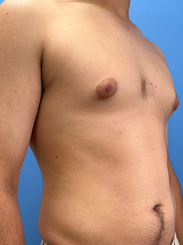 Gynecomastia Before & After Image
