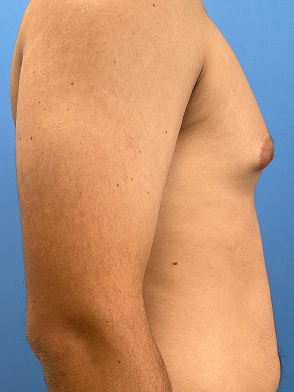 Gynecomastia Before & After Image