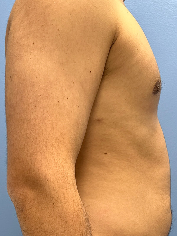 Gynecomastia Before & After Image