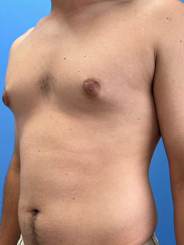 Gynecomastia Before & After Image
