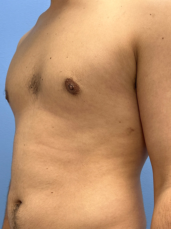 Gynecomastia Before & After Image