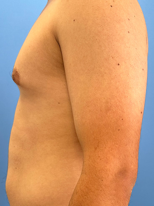 Gynecomastia Before & After Image