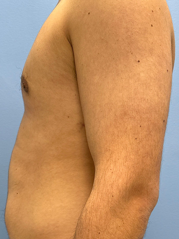 Gynecomastia Before & After Image