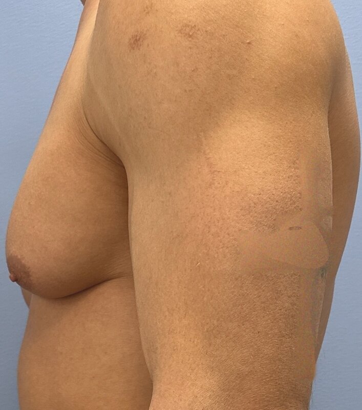 Gynecomastia Before & After Image