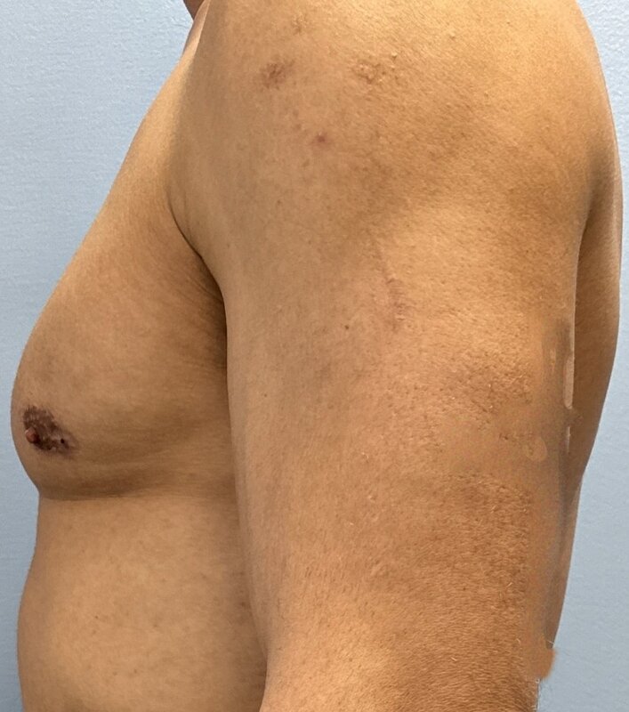 Gynecomastia Before & After Image