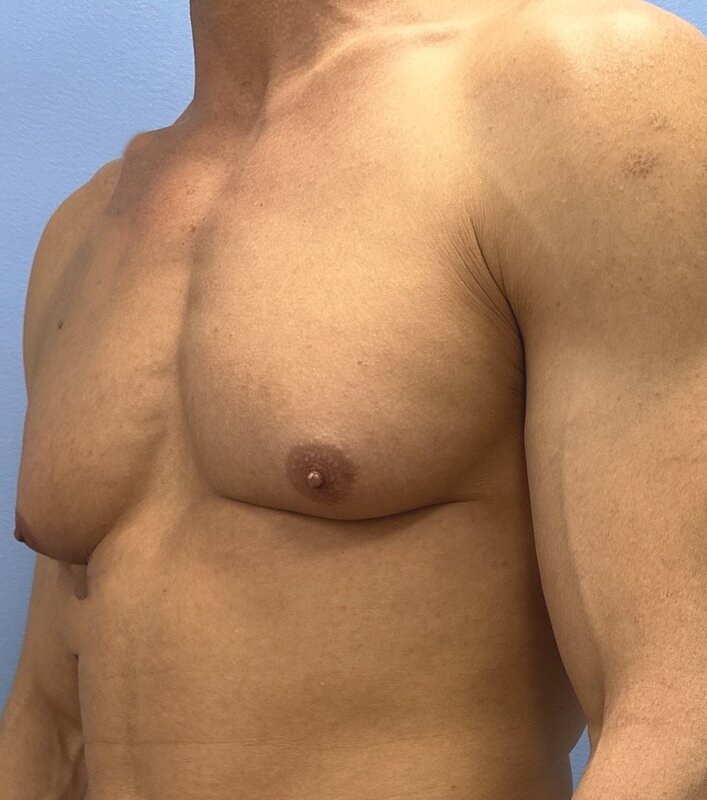 Gynecomastia Before & After Image