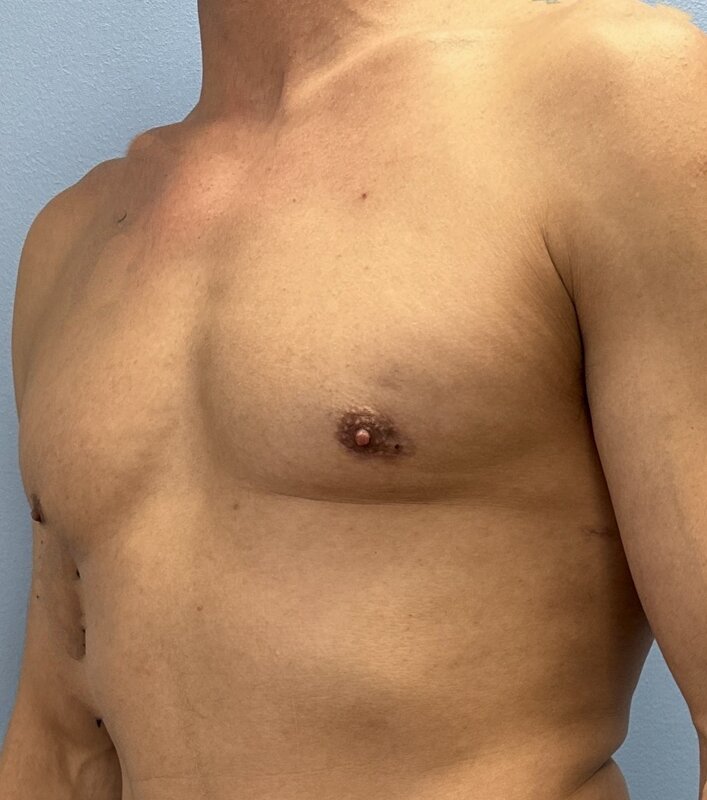 Gynecomastia Before & After Image