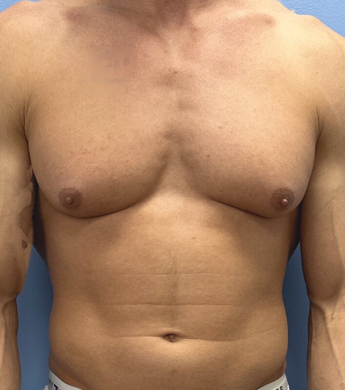 Gynecomastia Before & After Image