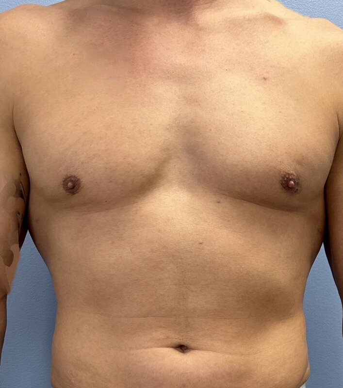 Gynecomastia Before & After Image