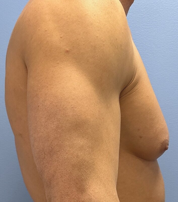 Gynecomastia Before & After Image