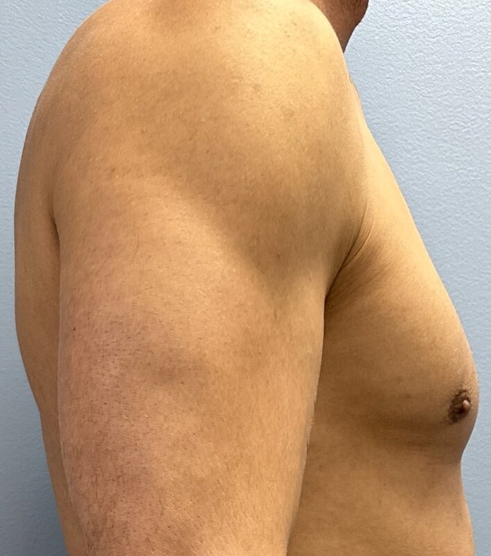 Gynecomastia Before & After Image