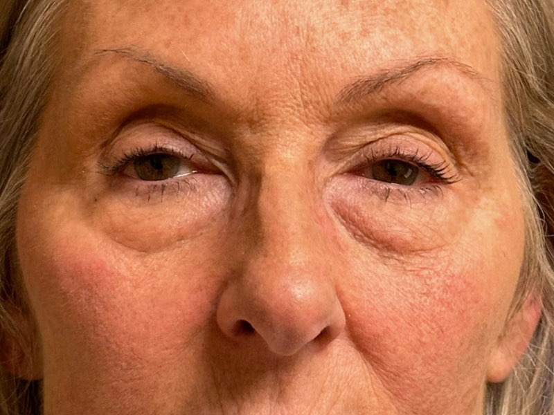 Blepharoplasty Before & After Image