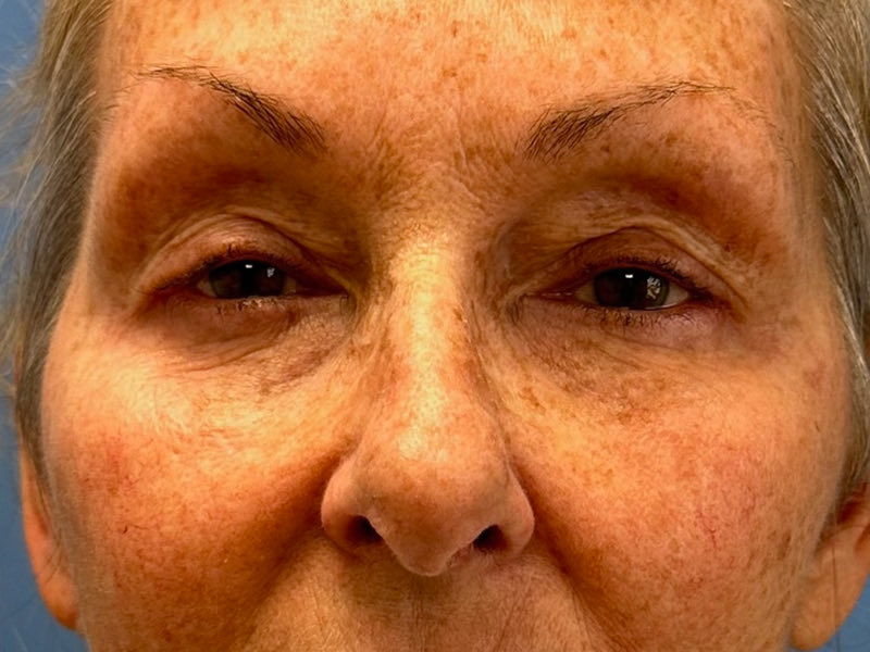 Blepharoplasty Before & After Image