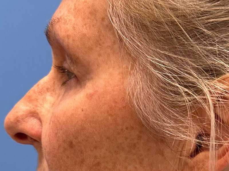 Blepharoplasty Before & After Image