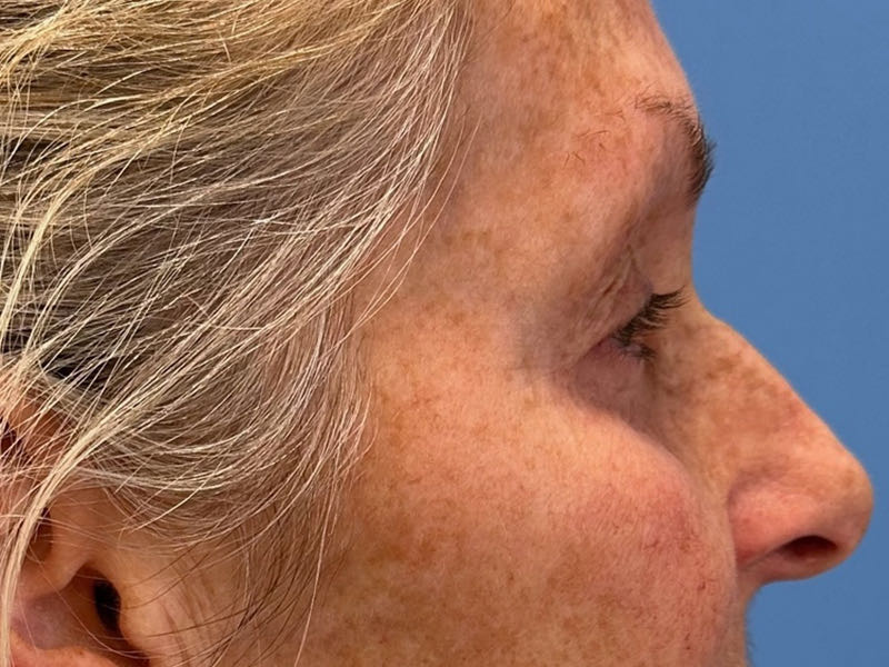 Blepharoplasty Before & After Image