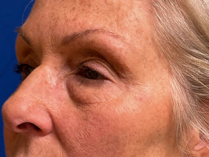 Blepharoplasty Before & After Image