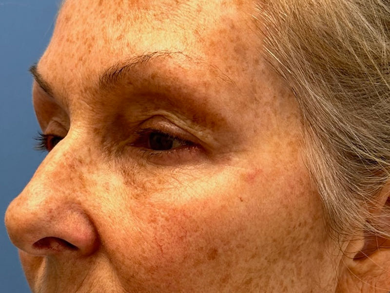 Blepharoplasty Before & After Image