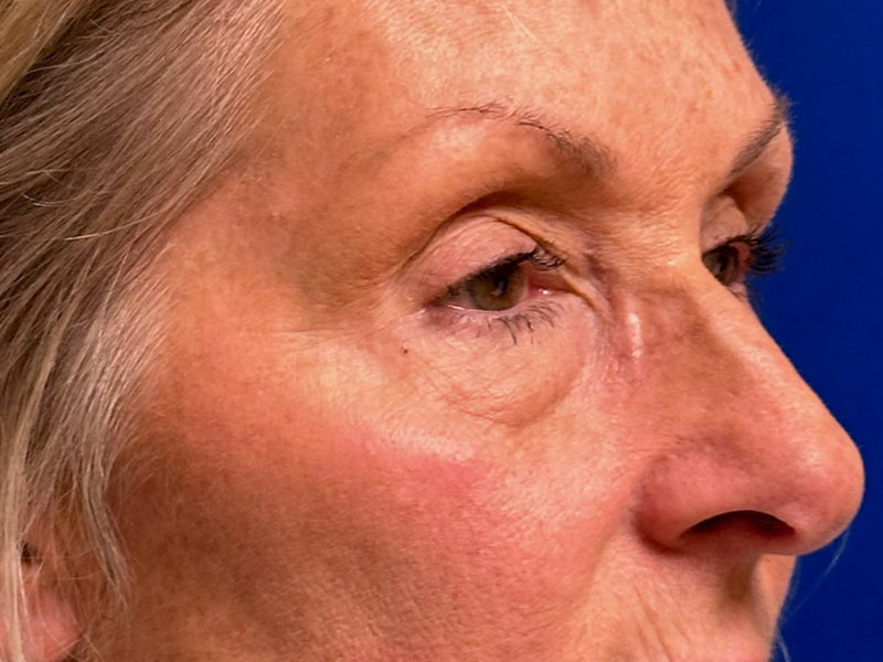 Blepharoplasty Before & After Image