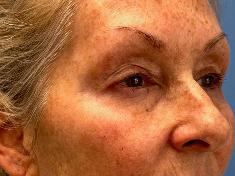 Blepharoplasty Before & After Image