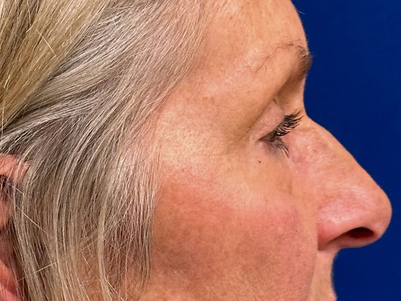 Blepharoplasty Before & After Image