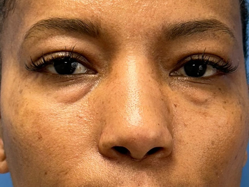 Blepharoplasty Before & After Image