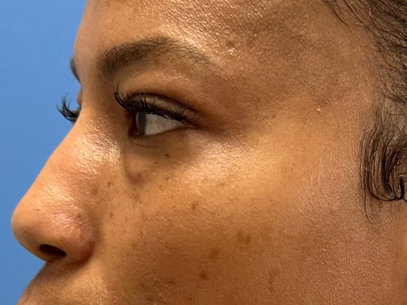 Blepharoplasty Before & After Image