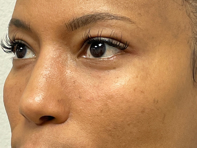 Blepharoplasty Before & After Image