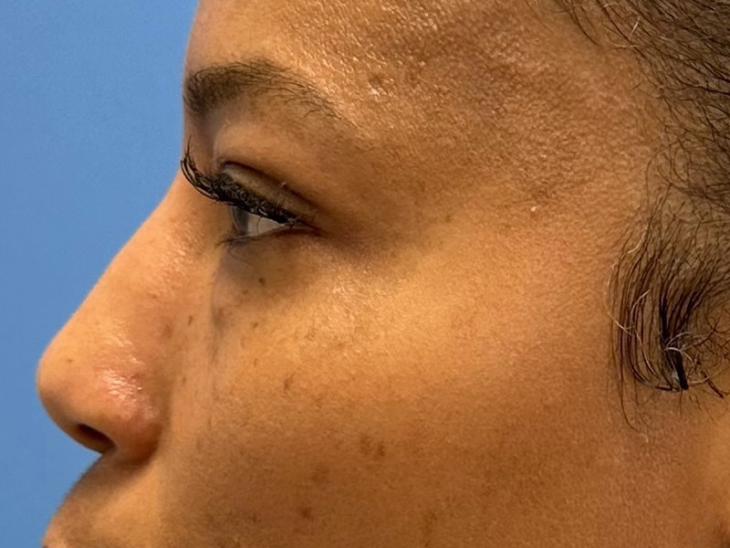 Blepharoplasty Before & After Image