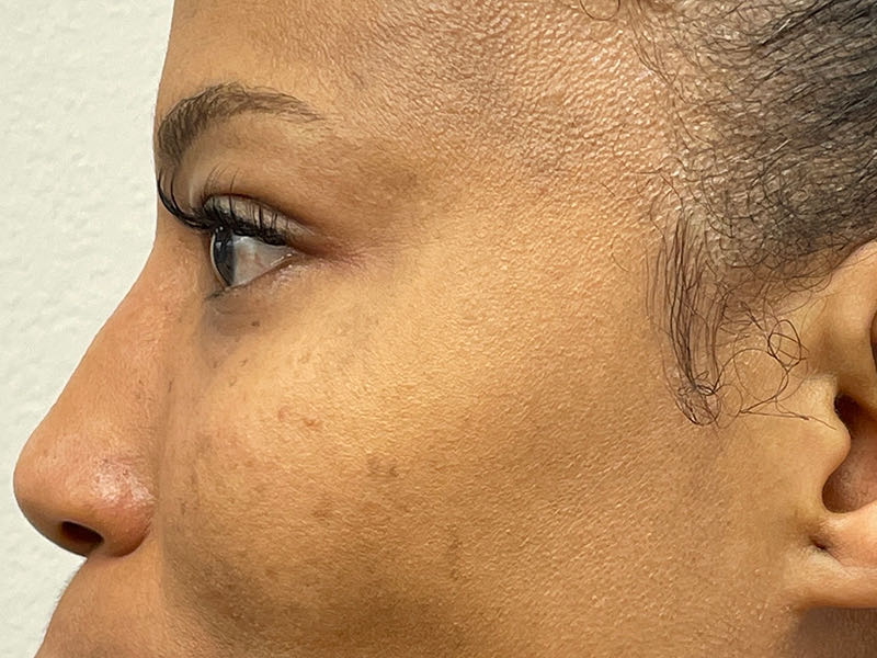 Blepharoplasty Before & After Image
