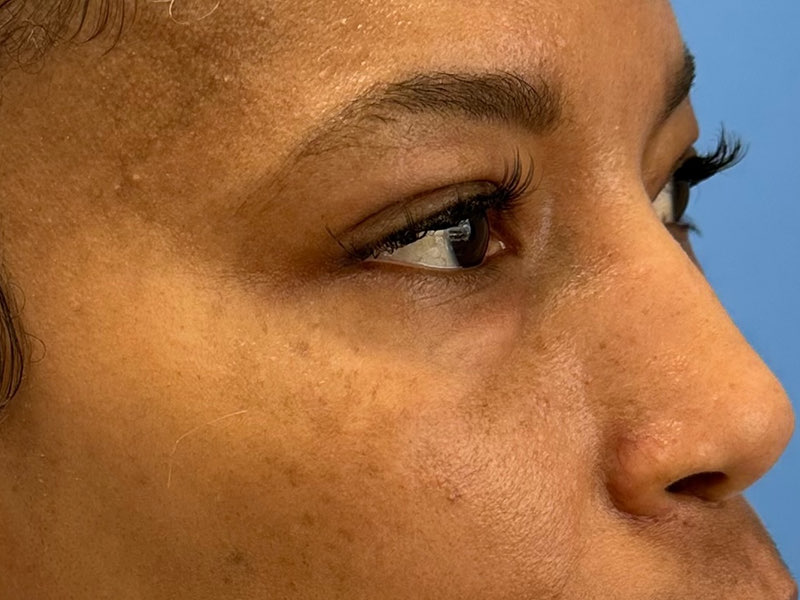Blepharoplasty Before & After Image