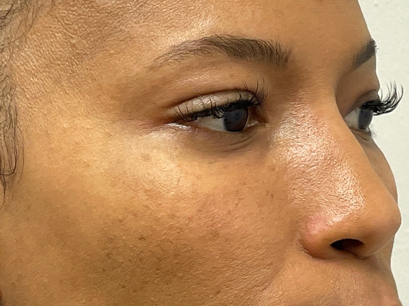 Blepharoplasty Before & After Image