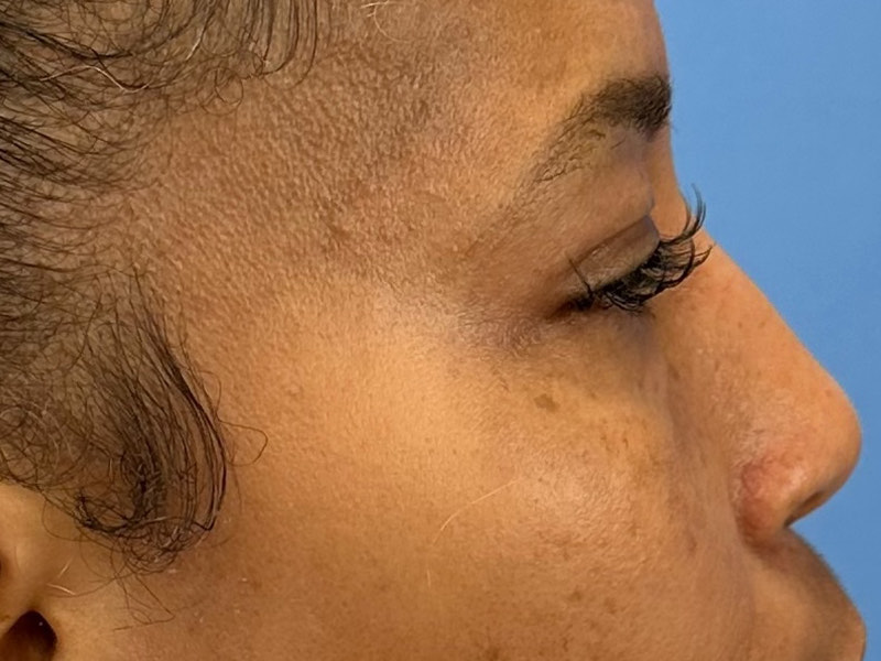 Blepharoplasty Before & After Image