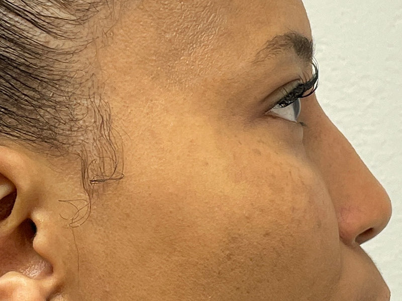 Blepharoplasty Before & After Image