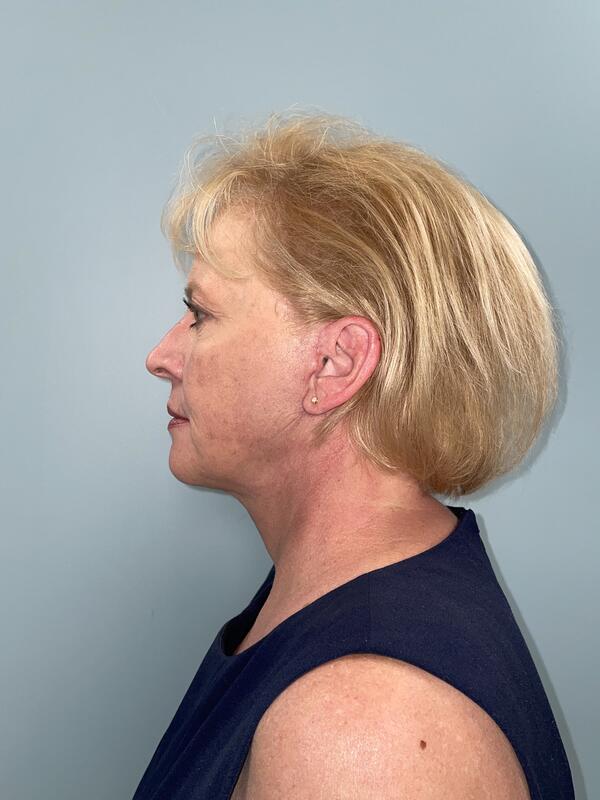 Face & Neck Lift Before & After Image