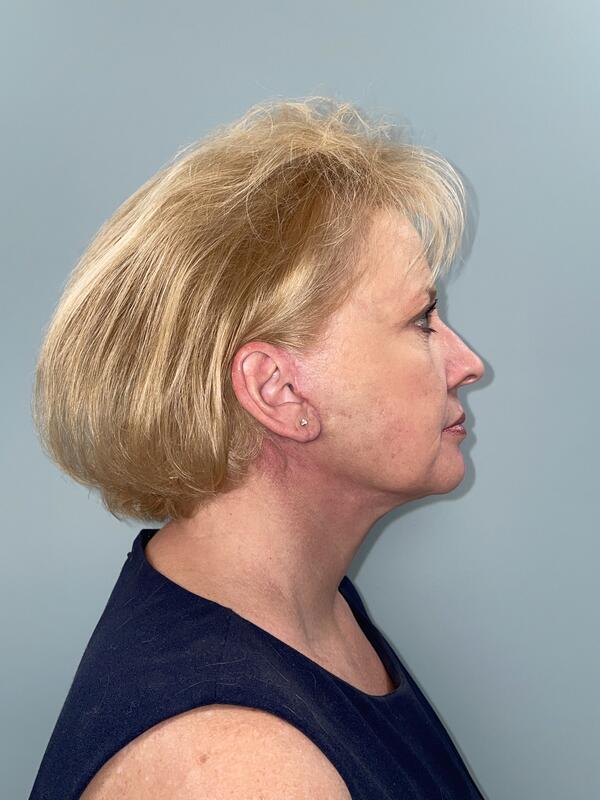 Face & Neck Lift Before & After Image