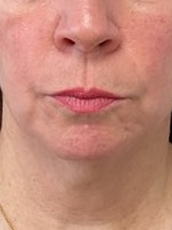Face & Neck Lift Before & After Image