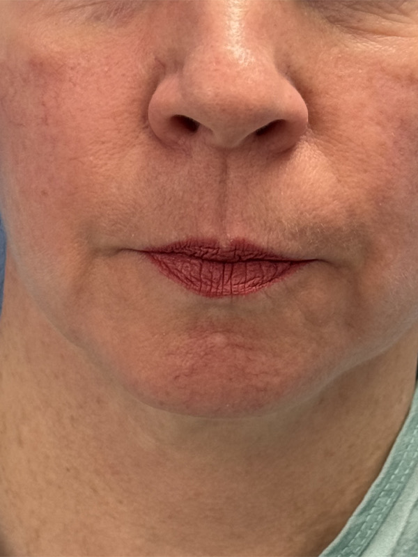 Face & Neck Lift Before & After Image