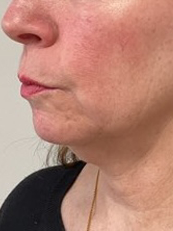 Face & Neck Lift Before & After Image