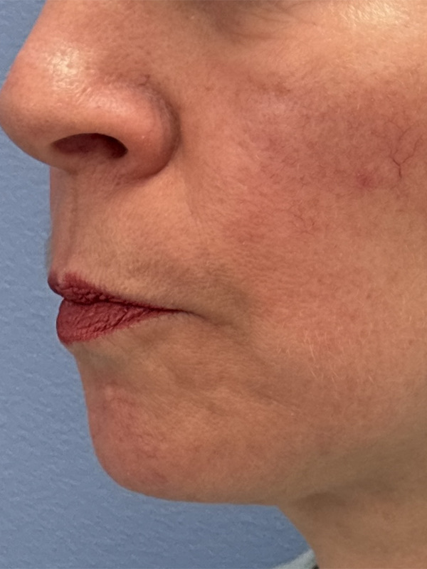 Face & Neck Lift Before & After Image