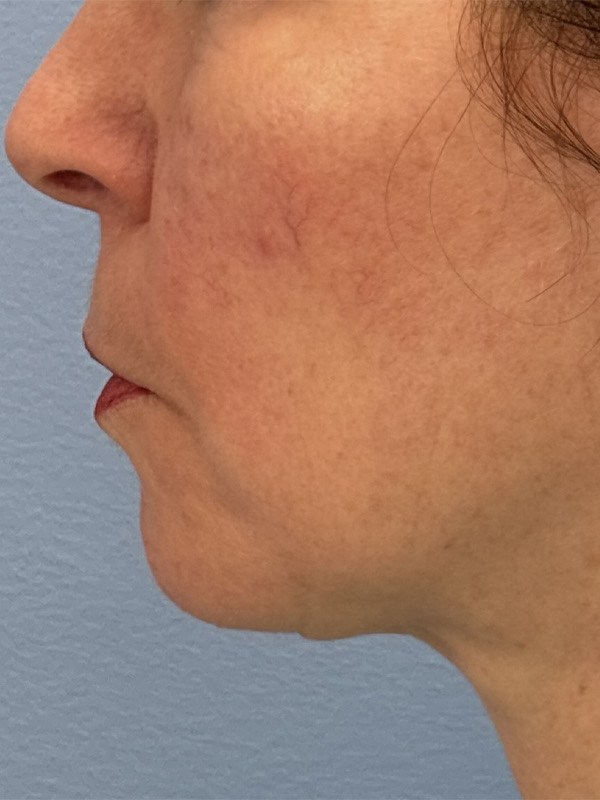 Face & Neck Lift Before & After Image