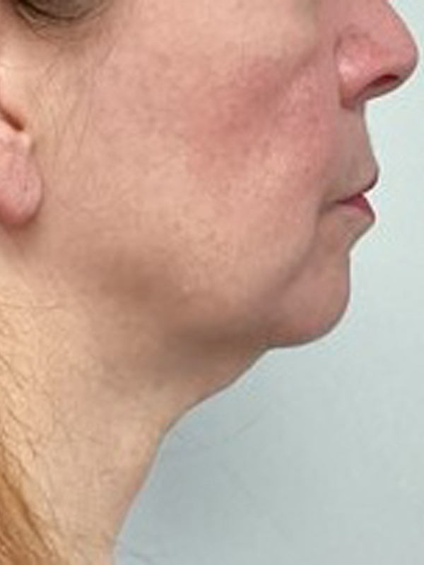 Face & Neck Lift Before & After Image