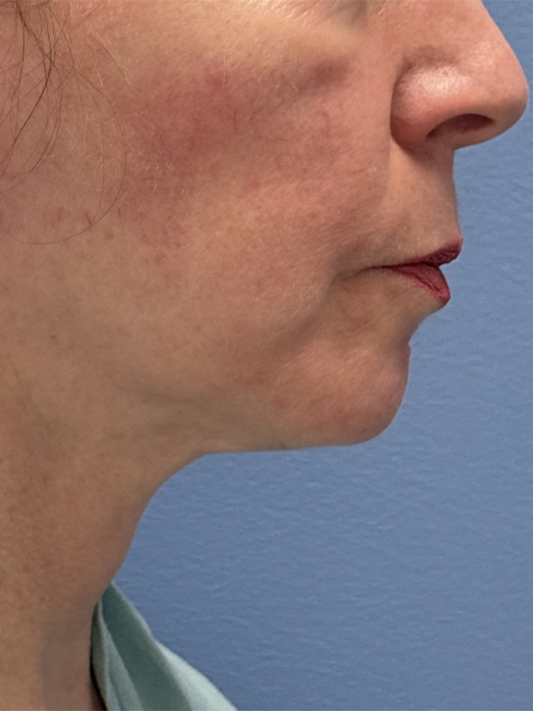 Face & Neck Lift Before & After Image